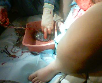 placenta coming out, white bagged naturally